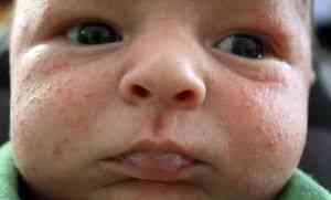 Прыщи у новорожденного на лице: неонатальный пустулез | БудьЛаска